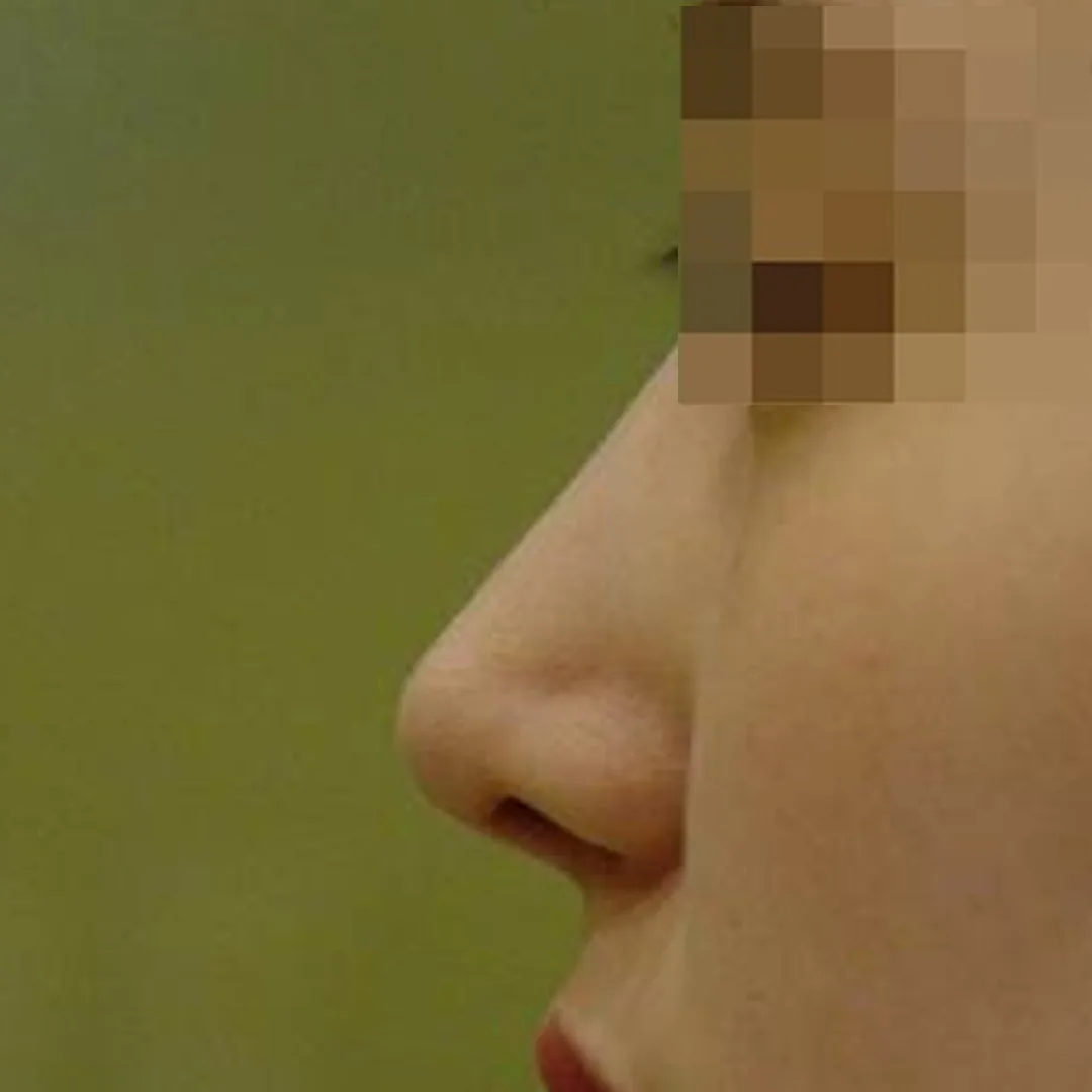 수술 후