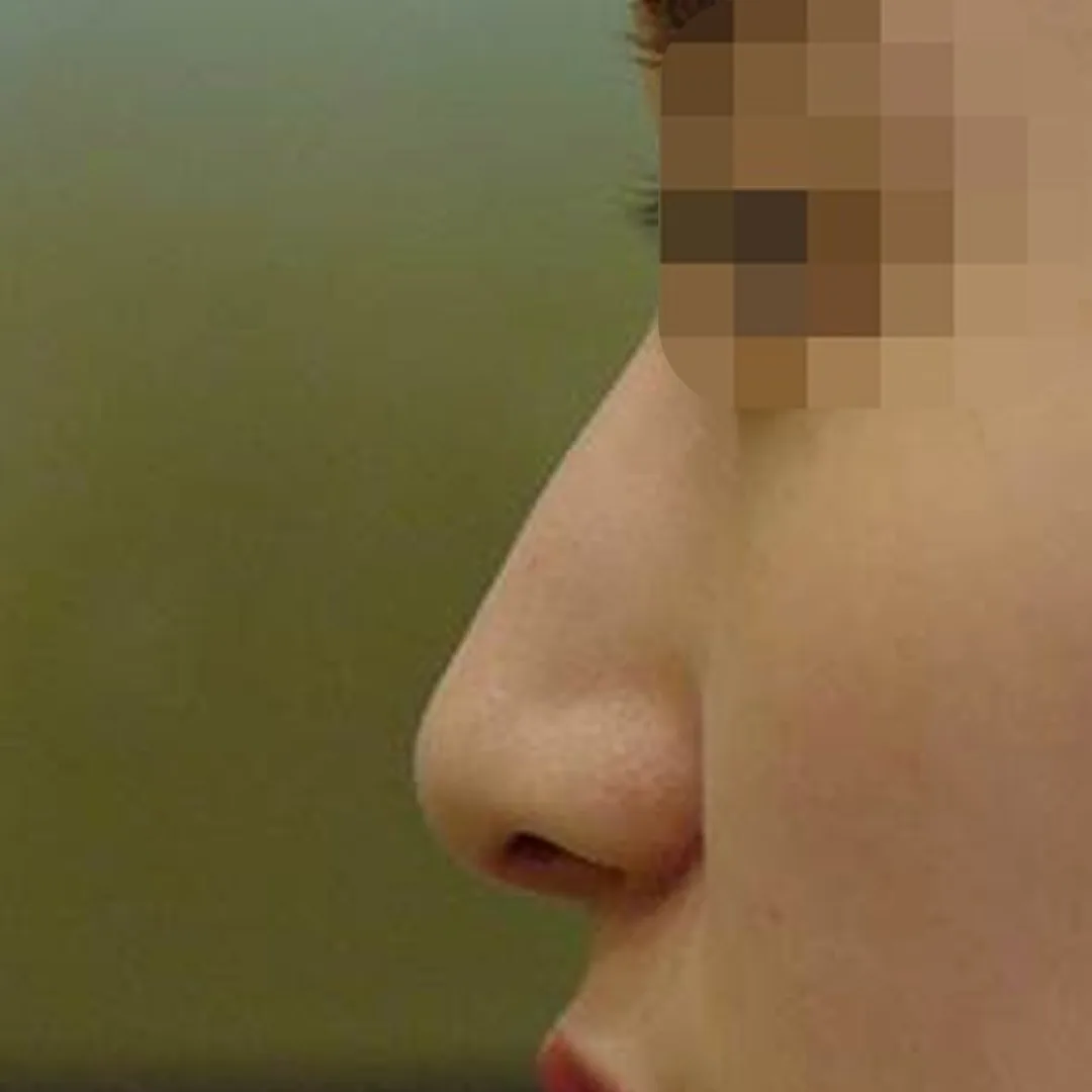 수술 전